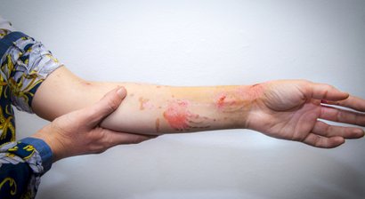 Behandlung von Verbrennungsverletzungen