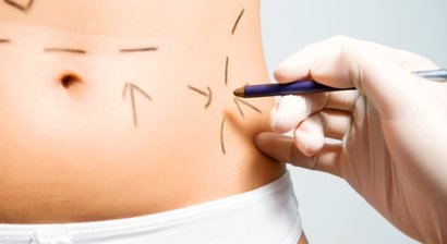 Bauchdeckenstraffung