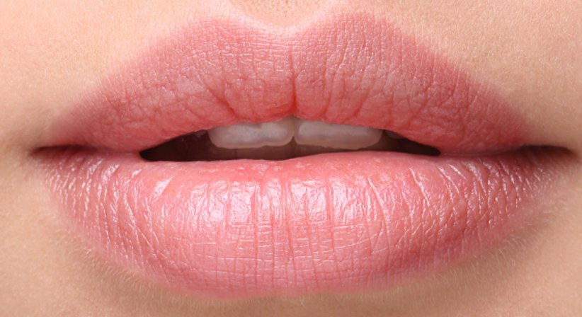 Lippenkorrektur - Dr. Andreas Hillisch - Plastischer Chirurg Eferding 4070