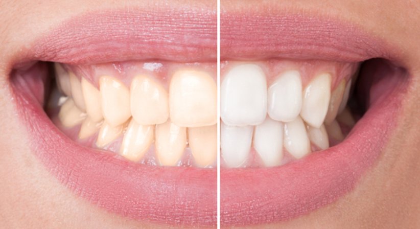 Bleaching und Veneers - DDr. Matthias Kristoferitsch - Zahnarzt Feldbach 8330