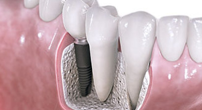 Zahnimplantate und Knochenaufbau - DDr. Matthias Kristoferitsch - Zahnarzt Feldbach 8330