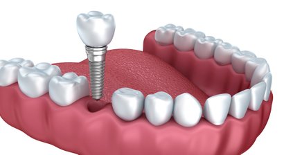 3D computernavigierte Implantologie