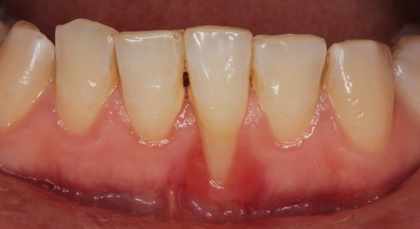 Individuelle Parodontitistherapie - Dr. Robert Stillmann, MSc - Zahnarzt Wien 1010