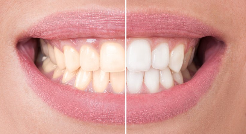 Bleaching - Dr. Robert Stillmann, MSc - Zahnarzt Wien 1010