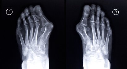 Hallux valgus