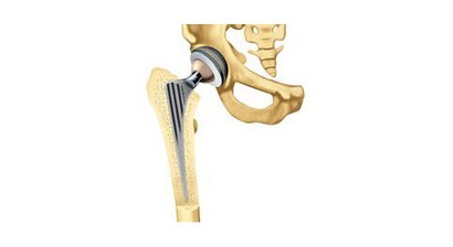 Hüftprothese
