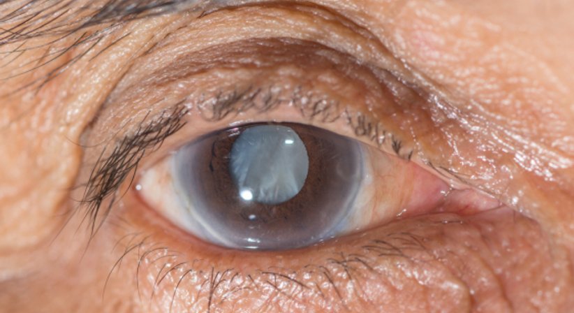 Grauer Star - OA Dr. Martin Prskavec - Augenarzt Wien 1010