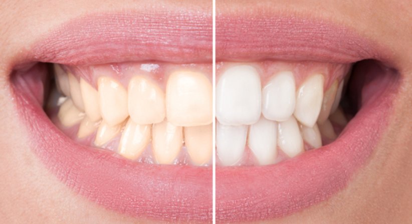 Bleaching - Dr. Birgit Hofer - Zahnärztin Wien 1010