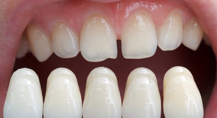 Veneers - Dr. Birgit Hofer - Zahnärztin Wien 1010