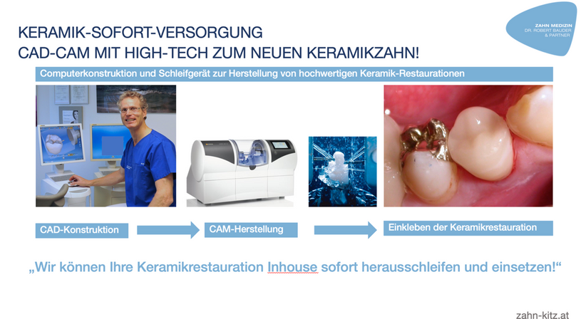 Zahnfüllung, Inlays (Amalgamsanierung, CAD-CAM) - Dr. Robert Bauder, MSc., MSc. - Zahnarzt Kitzbühel 6370