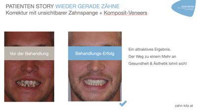 Unsichtbare Zahnspange/Aligner Therapie