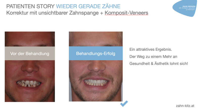 Unsichtbare Zahnspange/Aligner Therapie - Dr. Robert Bauder, MSc., MSc. - Zahnarzt Kitzbühel 6370