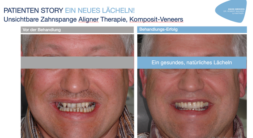 Veneers - Dr. Robert Bauder, MSc., MSc. - Zahnarzt Kitzbühel 6370