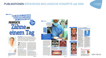 Feste-Zähne-Sofort: Versorgung mit CAD-CAM, abdruckfrei