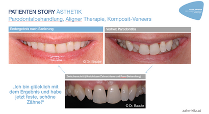 Parodontale Sanierung (Parodontitis)