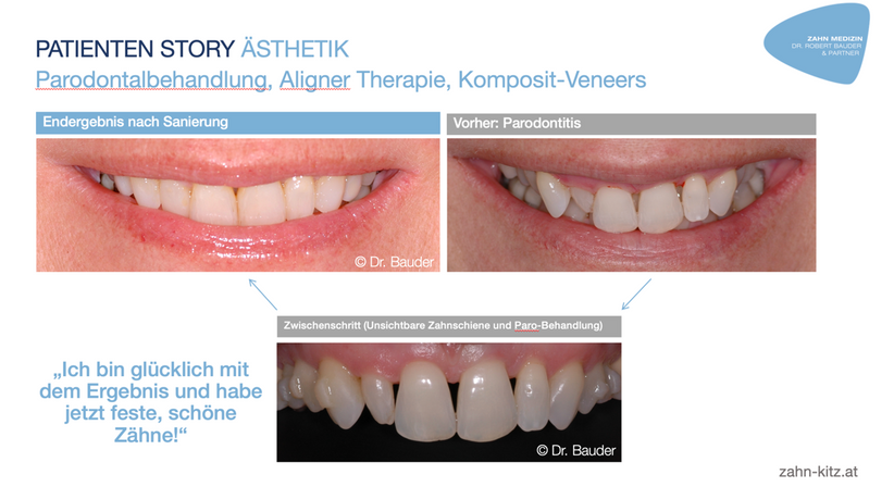 Parodontale Sanierung (Parodontitis) - Dr. Robert Bauder, MSc., MSc. - Zahnarzt Kitzbühel 6370