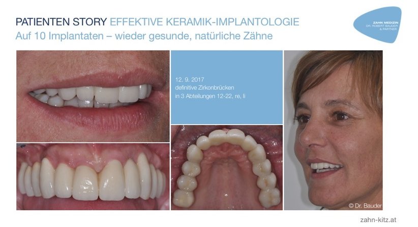Ästhetische Behandlungen und Sanierungen - Dr. Robert Bauder, MSc., MSc. - Zahnarzt Kitzbühel 6370