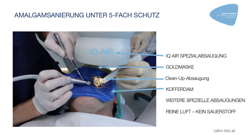 Amalgamsanierungen - Dr. Robert Bauder, MSc., MSc. - Zahnarzt Kitzbühel 6370