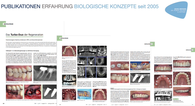 Zahnimplantate (Keramik/Titan), Zahnersatz - Dr. Robert Bauder, MSc., MSc. - Zahnarzt Kitzbühel 6370