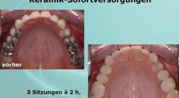 Zahnfüllung, Inlays (Amalgamsanierung, CAD-CAM) -