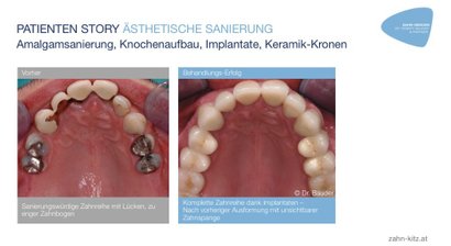 Patienteneigene Wachstumsfaktoren, Stammzellen (i-PR, A-PRF)