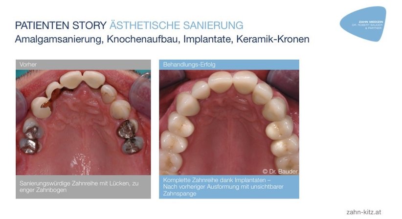 Patienteneigene Wachstumsfaktoren, Stammzellen (i-PR, A-PRF) - Dr. Robert Bauder, MSc., MSc. - Zahnarzt Kitzbühel 6370