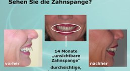 Unsichtbare Zahnspange -