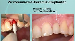 Zahnimplantate -