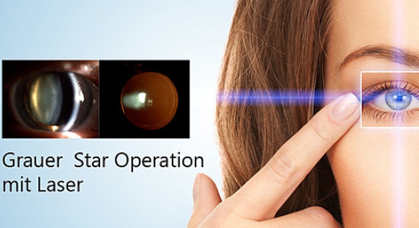 Grauer Star - Prim. Univ.-Prof. Dr. Matthias Bolz - Augenarzt Linz 4020