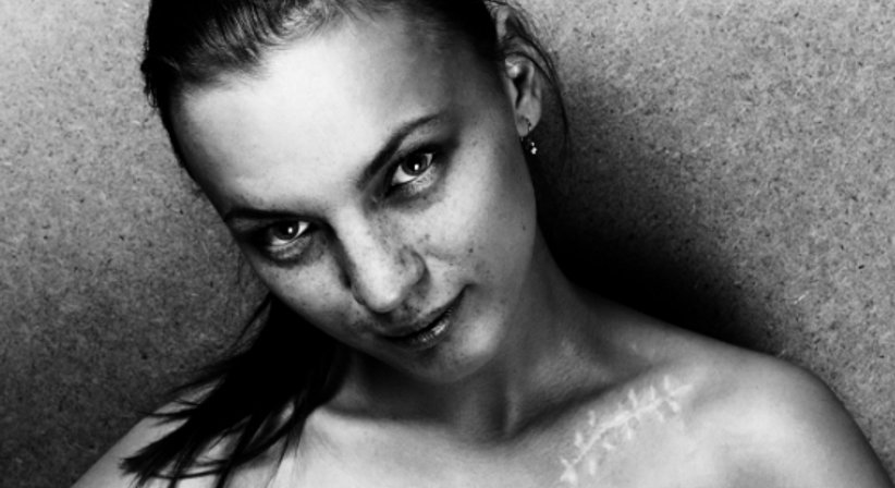 Narbenkorrektur - Dr. Claudia Gschnitzer - Plastische Chirurgin Wien 1090