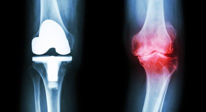 Gonarthrose (Kniearthrose)