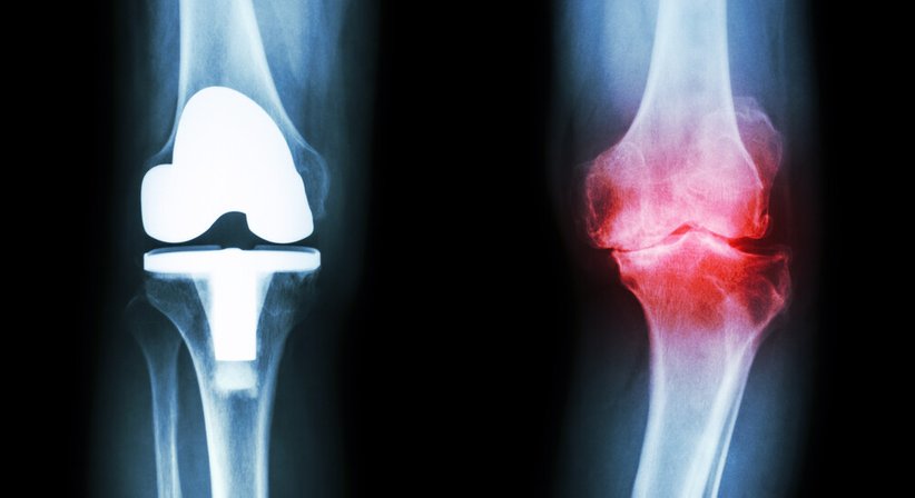 Gonarthrose (Kniearthrose) - OA Dr. Georg Brandl - Orthopäde Wien 1190