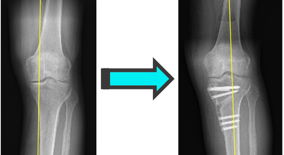 Beinachsenkorrektur / Umstellungsosteotomie