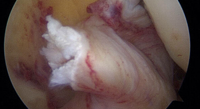 Kreuzbandriss / Bandrekonstruktion / Kreuzbandplastik