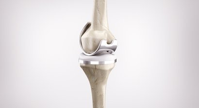 3D gestützter Kniegelenkersatz (MyKnee®) / Knieendoprothetik