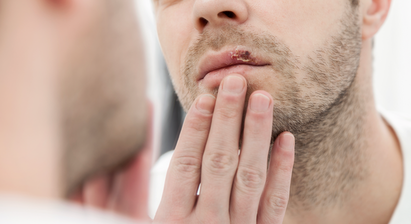 Herpes Simplex (Lippenherpes / Fieberblase) - Dr.med.univ. Michael Skoll - Hautarzt Wien 1110