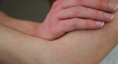 Neurodermitis (Atopische Dermatitis)