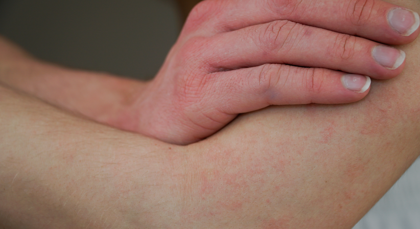 Neurodermitis (Atopische Dermatitis) - Dr.med.univ. Michael Skoll - Hautarzt Wien 1110