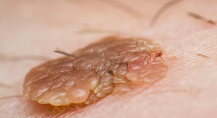 HPV - Dr.med.univ. Michael Skoll - Hautarzt Wien 1110