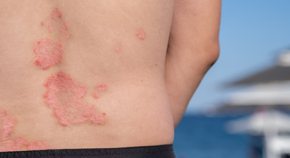 Schuppenflechte (Psoriasis)