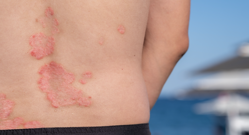 Schuppenflechte (Psoriasis) - Dr.med.univ. Michael Skoll - Hautarzt Wien 1110