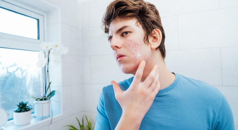 Akne und Hautunreinheiten - Dr.med.univ. Michael Skoll - Hautarzt Wien 1110