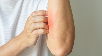 Hautausschlag/Ekzeme