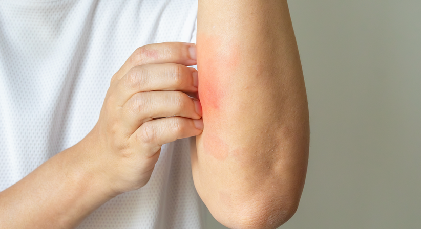 Hautausschlag/Ekzeme - Dr.med.univ. Michael Skoll - Hautarzt Wien 1110