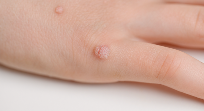 Warzen - Dr.med.univ. Michael Skoll - Hautarzt Wien 1110