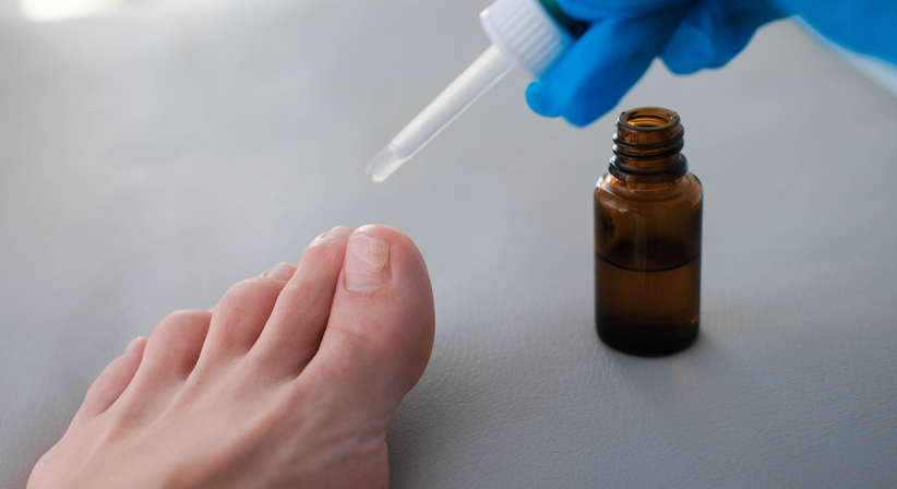 Nagelpilz - Dr.med.univ. Michael Skoll - Hautarzt Wien 1110