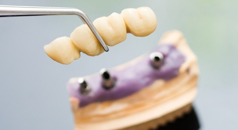 Kronen und Brücken - DDr. Birgit Podesser - Zahnärztin Wien 1120