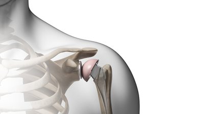 Schulterendoprothesen (Künstliches Schultergelenk) bei Arthrose