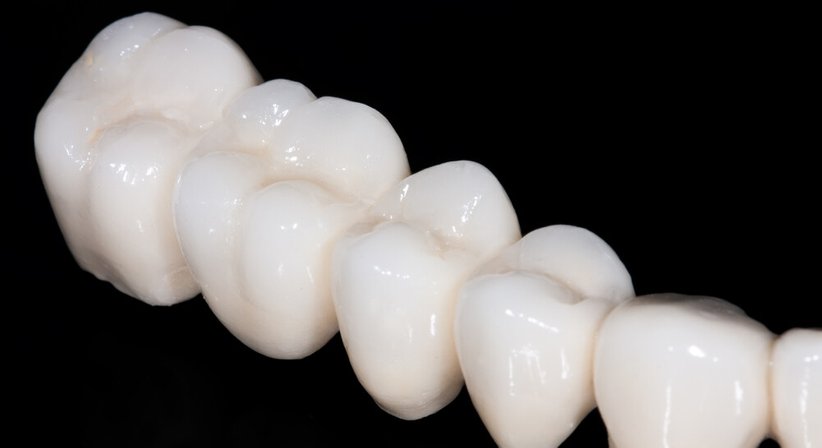 CEREC®- Methode - DDr. Ronald Ringl - Zahnarzt Wien 1030