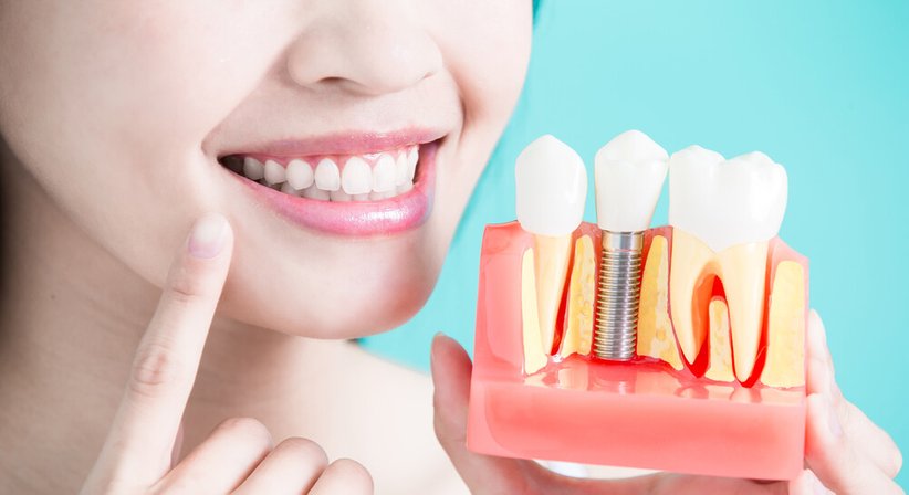 Implantologie - DDr. Ronald Ringl - Zahnarzt Wien 1030